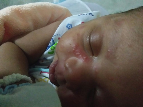 หน้าและหัวน้องเป็นผื่นเม็ดๆ