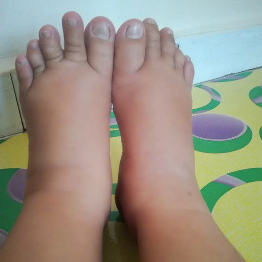kaki bengkak