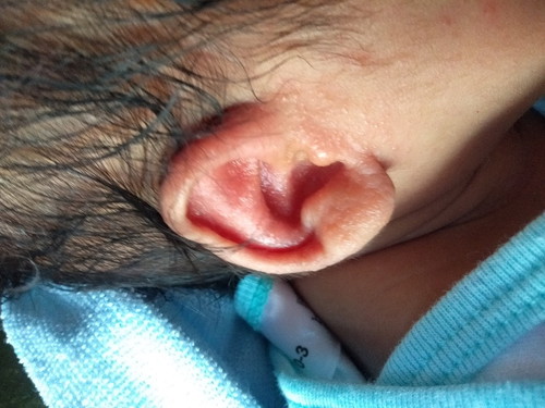 ตุ่มน้ำที่หู