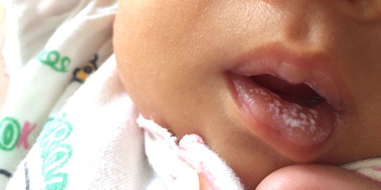 Bercak putih pada mulut