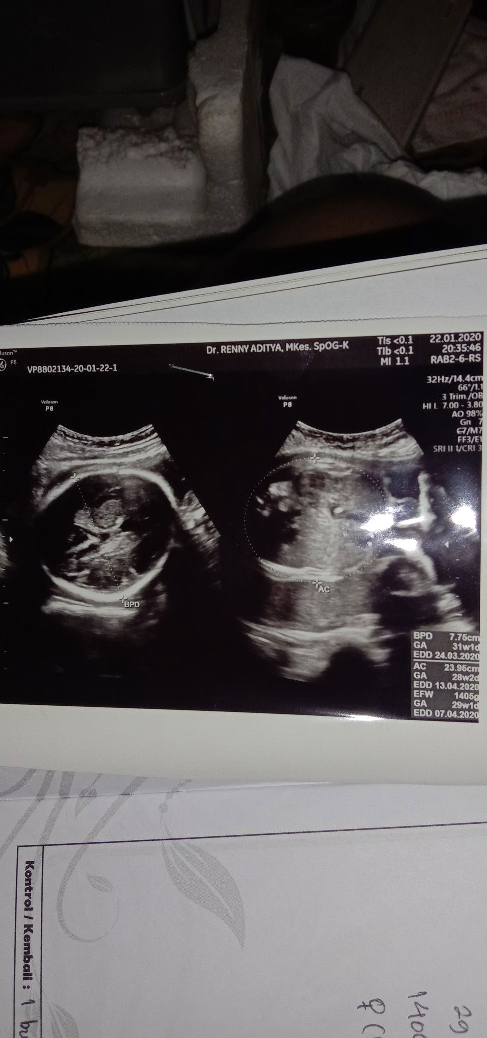 Cara membaca hasil USG