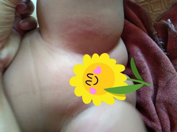 ลูกสาวเป็นผื่นเเดงข้างขาเเละตรงจิมิ