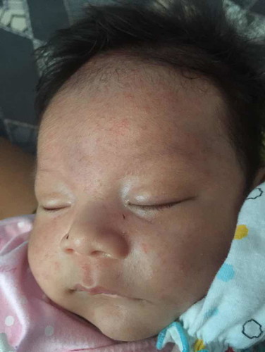 ใช่ผดร้อนไหม