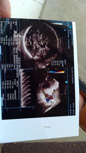 bayi terlilit talipusar 2x