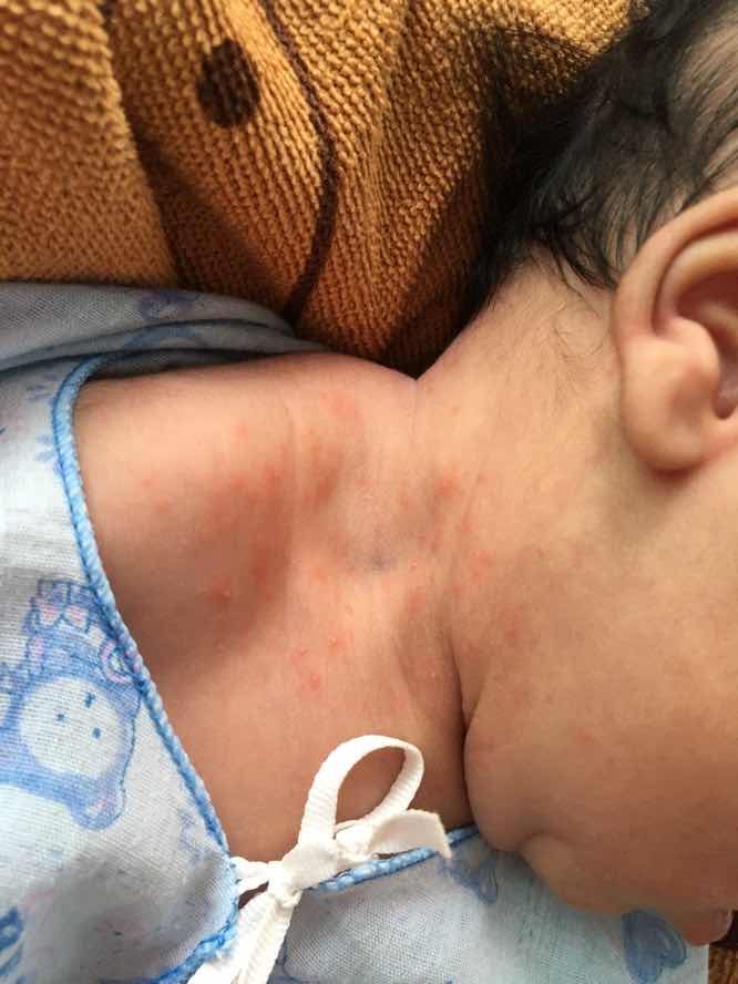 ตุ่มนี้คืออะไรค่ะ แม่ๆคนไหนใครรู้บอกหน่อยค่ะ