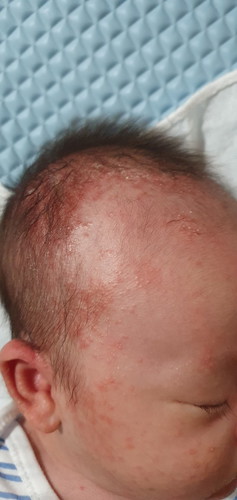 Newborn Rash