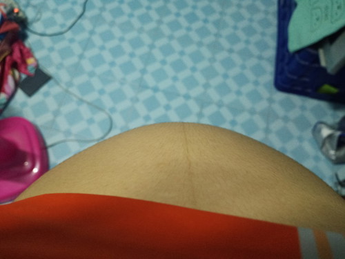 มีก้อนประมาณเท่ากำปั้นโผล่