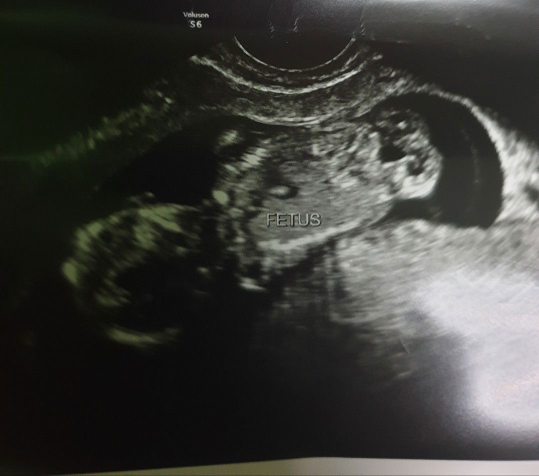 Myometrial Focal Contractions at 13 weeks