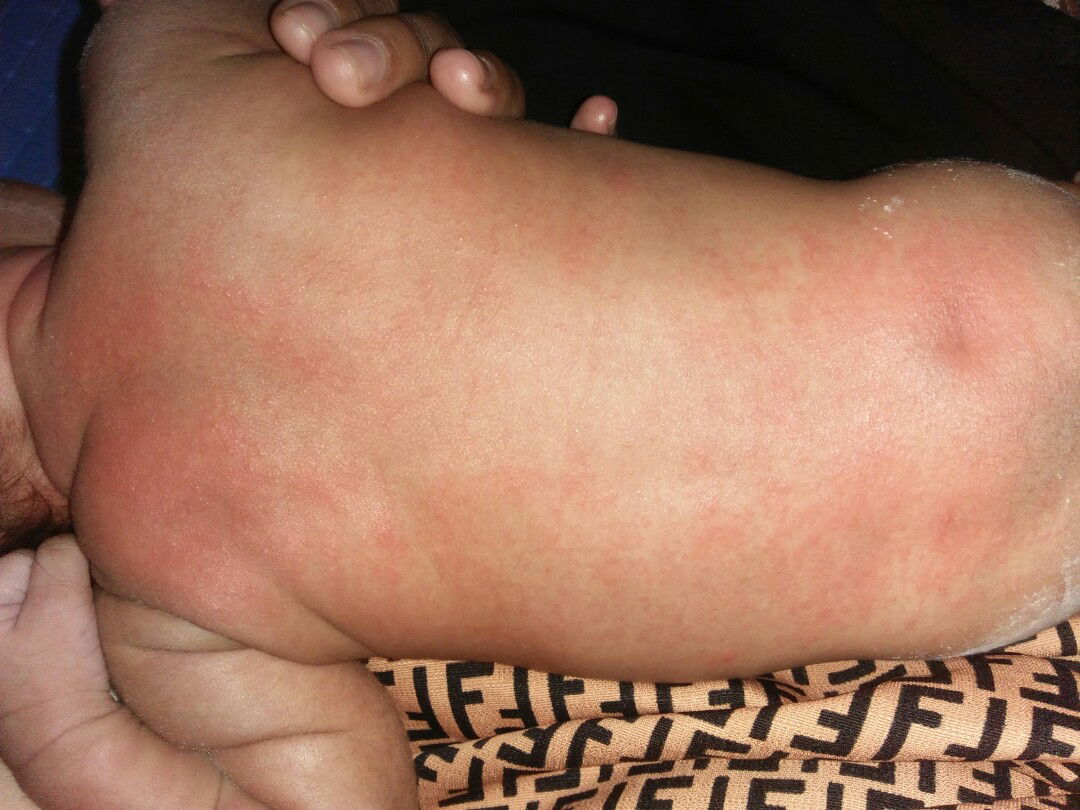 seluruh badan merah2