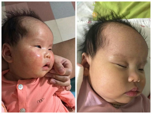 Nhà mình ai có bé bị chàm sữa (lác sữa) không?