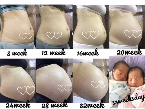 เป็นกำลังใจให้แม่ที่มีภาวะคลอดก่อนกำหนดนะคะ