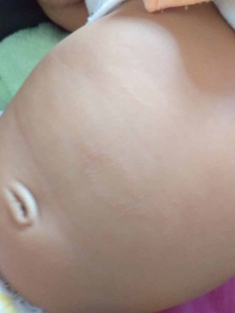 ลูกผื่นขึ้นเป็นดวงๆคล้ายเริม อยากทราบว่าใช่ไหมหรือเป็นอย่างอื่นครับ