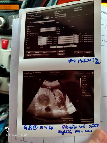 fibroid ketika hamil 16w