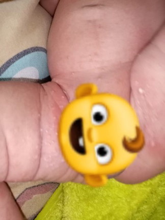 Diaper Rash?