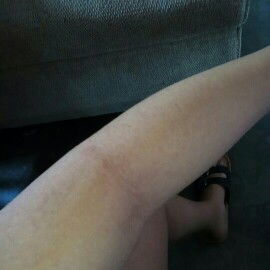 Ano po kaya yan di po ko kaya yan allergy or tigras o tigdas na ngangati mo siya then na namumula na butol butol po siya sbrang kati po dipo kaya siya apektado kay baby please Help me po nag aalalang po ako 6 mnths na po siya Then January po ako mangangan