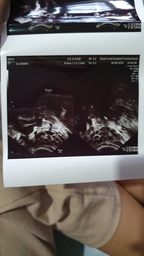 ตอนนี้ท้องได้ 11 w 2 d แล้วค่ะแต่เป็นซีสต์ที่รังไข่ด้วย