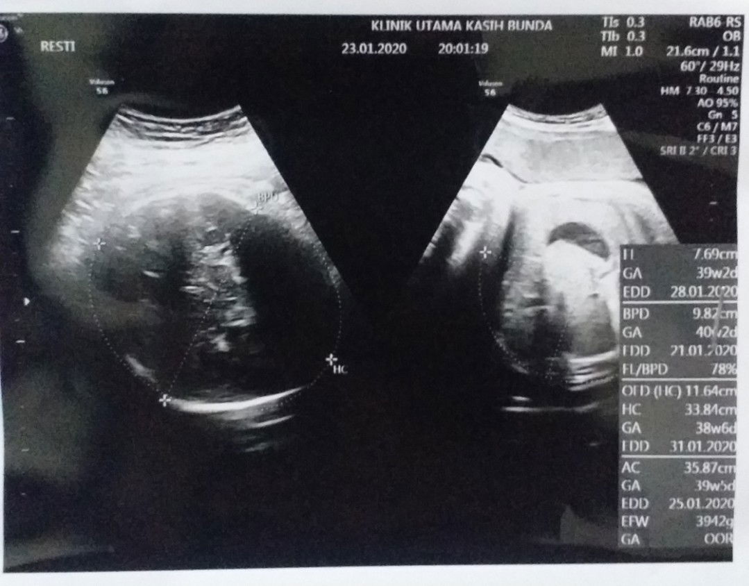 Bayi Tergolong Besar ? Lebih baik normal atau Caesar ? ☹