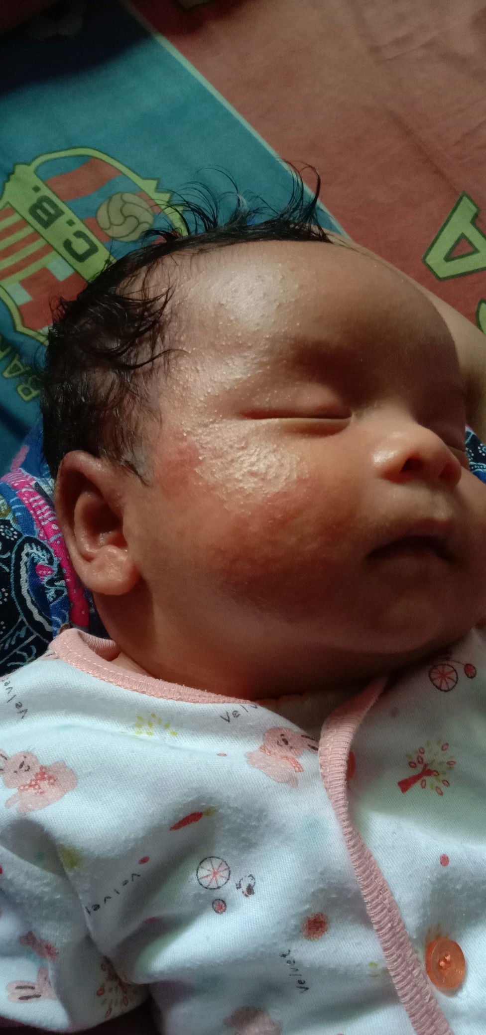 bayi beruntusan