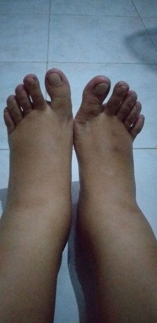 edema/kaki bengkak
