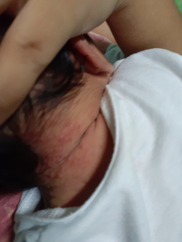 rashes sa likod ng leeg ni baby