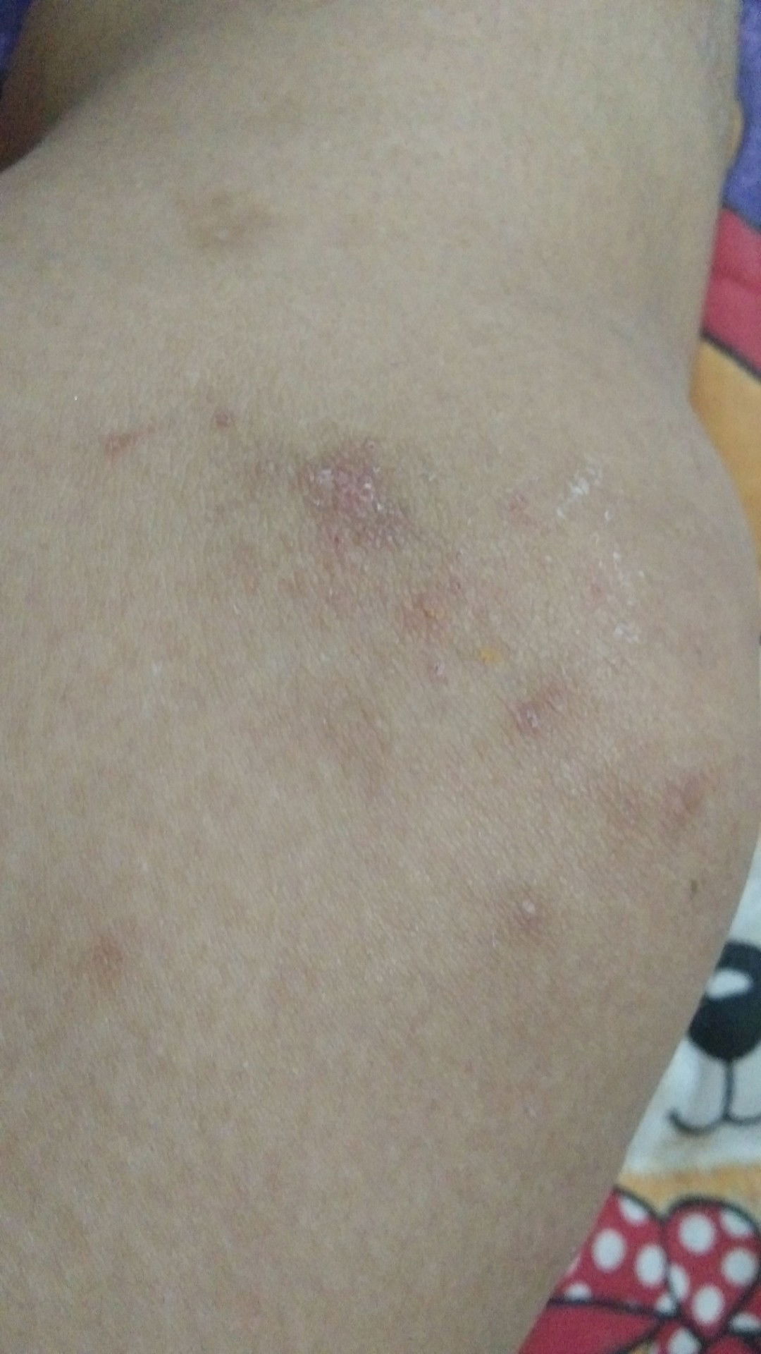 gatal gatal saat hamil