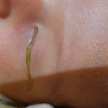 mata bayi 3 hari banyak kotoran