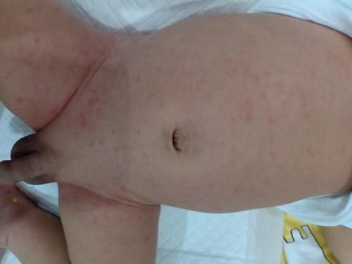 ผื่นในเด็กทารก