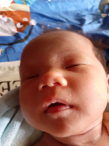 มีตุ่มขาวที่หน้า มันคือรัยหรอค่ะ