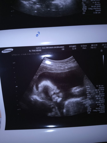 อัลตร้าซาวด์