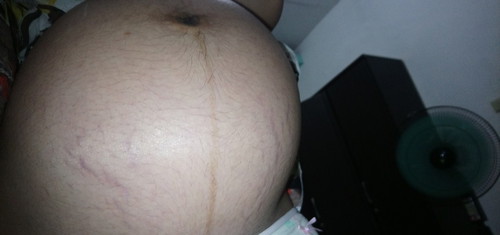 Stretchmark At 35weeks