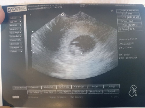 my 9 weeks ultrasound