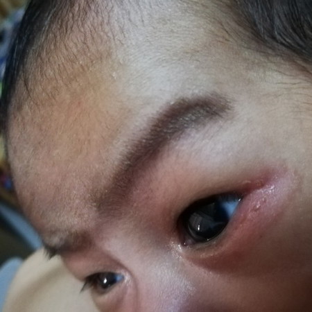 Sugat sa gilid ng mata ng baby