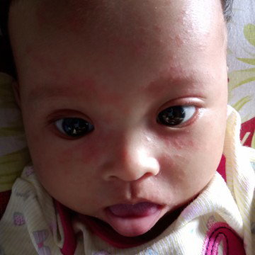 kemerahan pada bayi