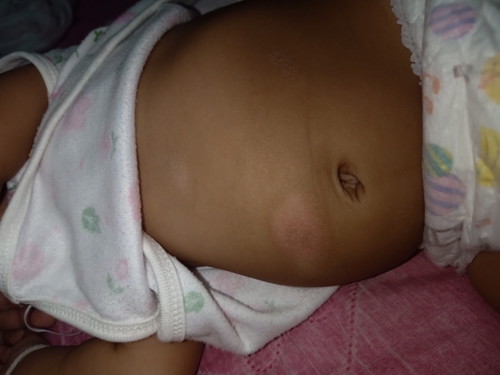 เป็นผื่นหรือขี้กลาก