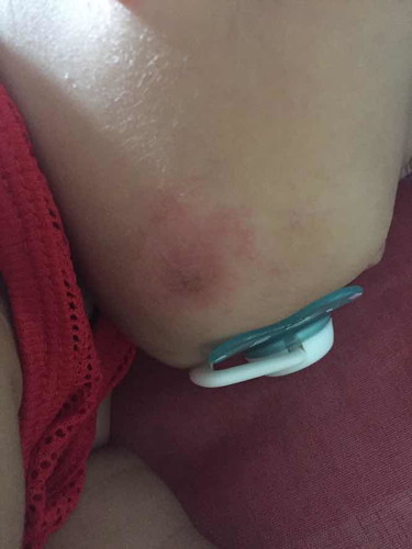 แพ้น้ำลาย