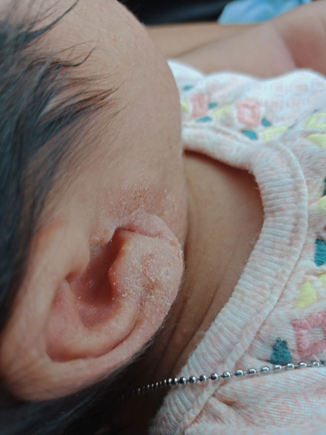 หูลูกแห้งแล้วเหมือนมีน้ำเหลืองออกมาค่ะตามภาพ