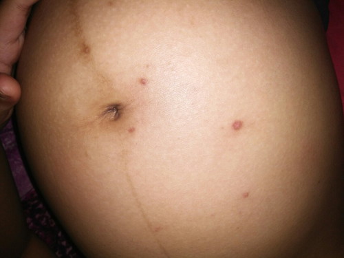 gatal gatal di perut usia hamil ,6 bulan