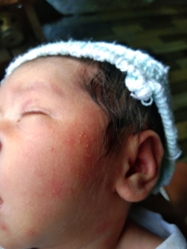 rashes sa mukha at ears ni baby