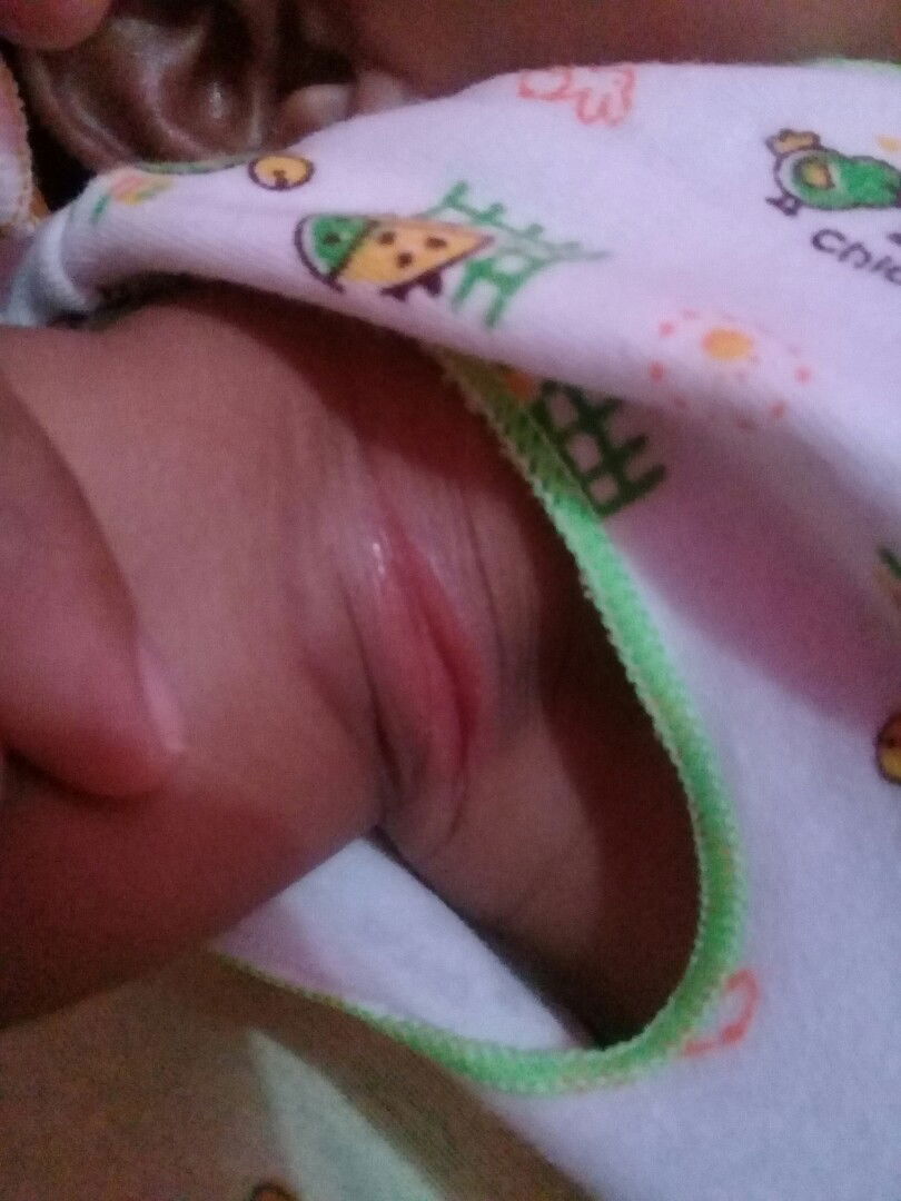 luka pada lipatan ketiak