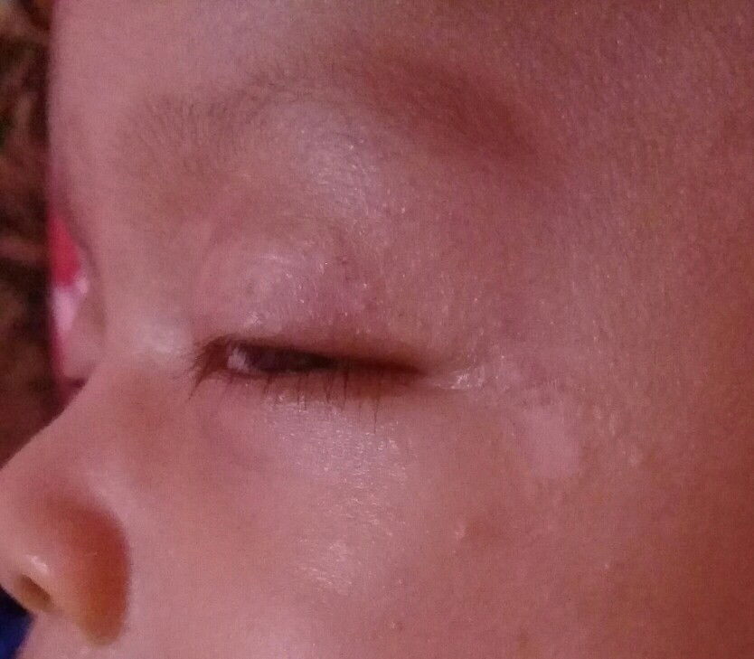 jerawat bayi bukan ya?