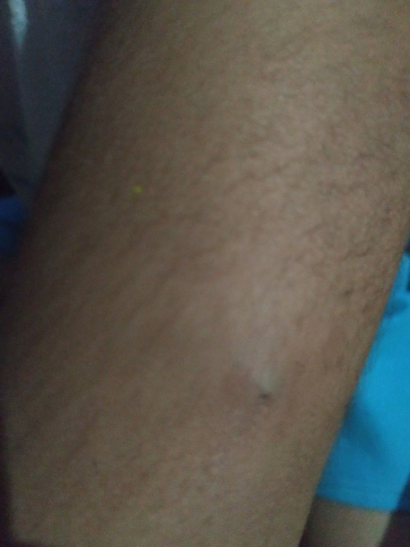 Pigsa Or Nakagat Lang Po?