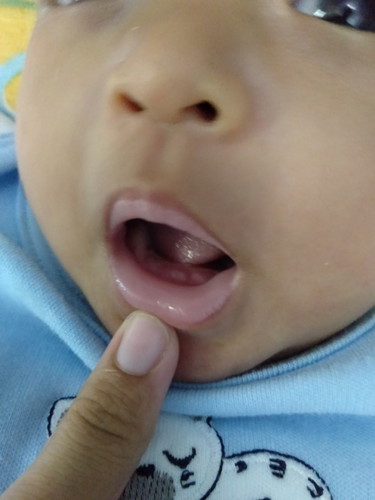 ฟันน้ำนม