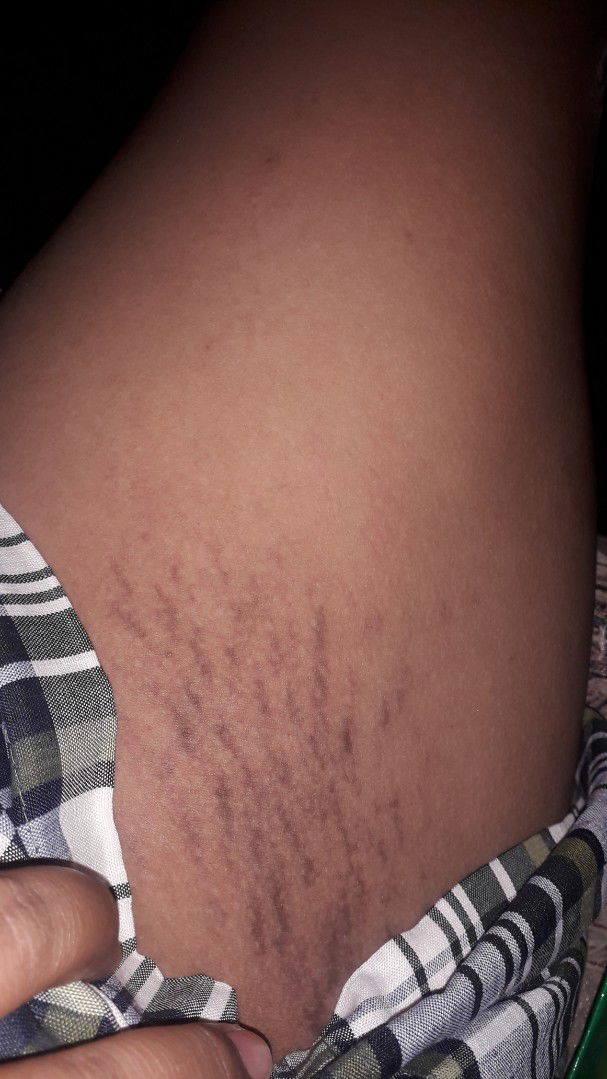 Strech Mark