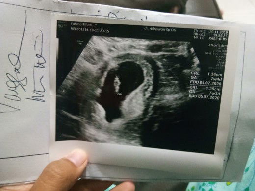 janin tidak berkembang