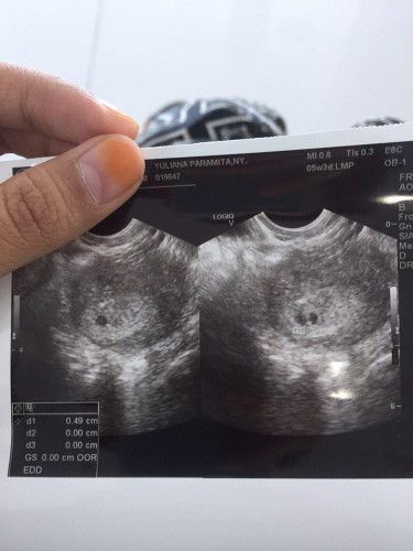 usia usg tidak sama dengan HPHT