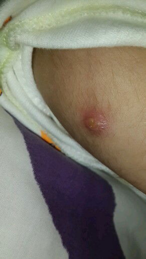 Bekas Imunisasi BCG
