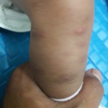 gigit nyamuk