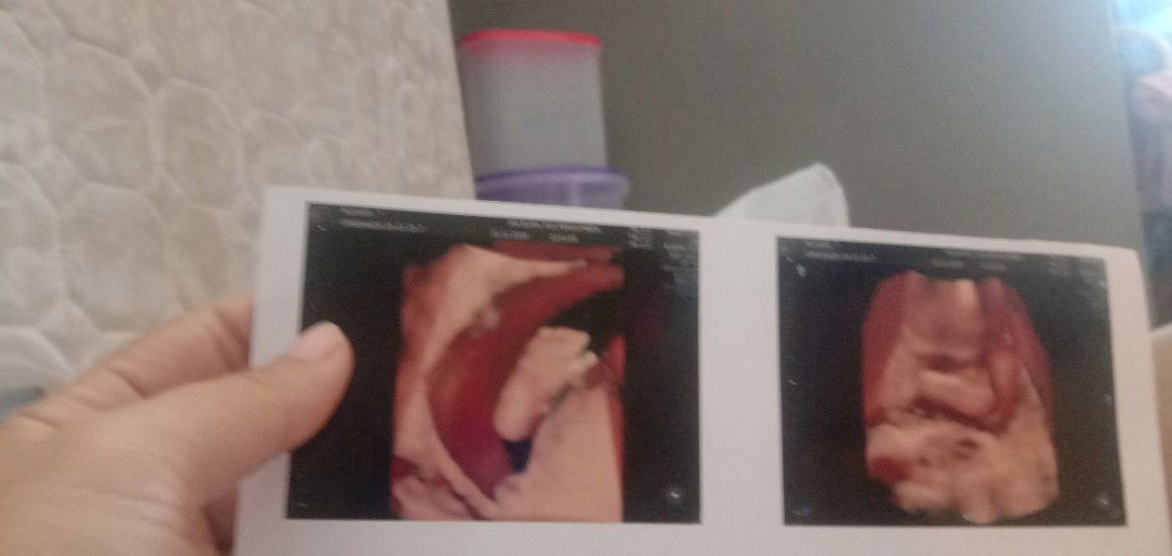 masih ragu hasil usg