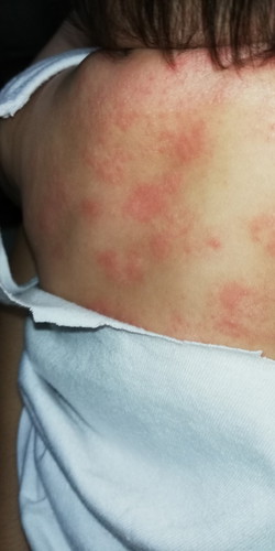 ECZEMA OR RASHES?