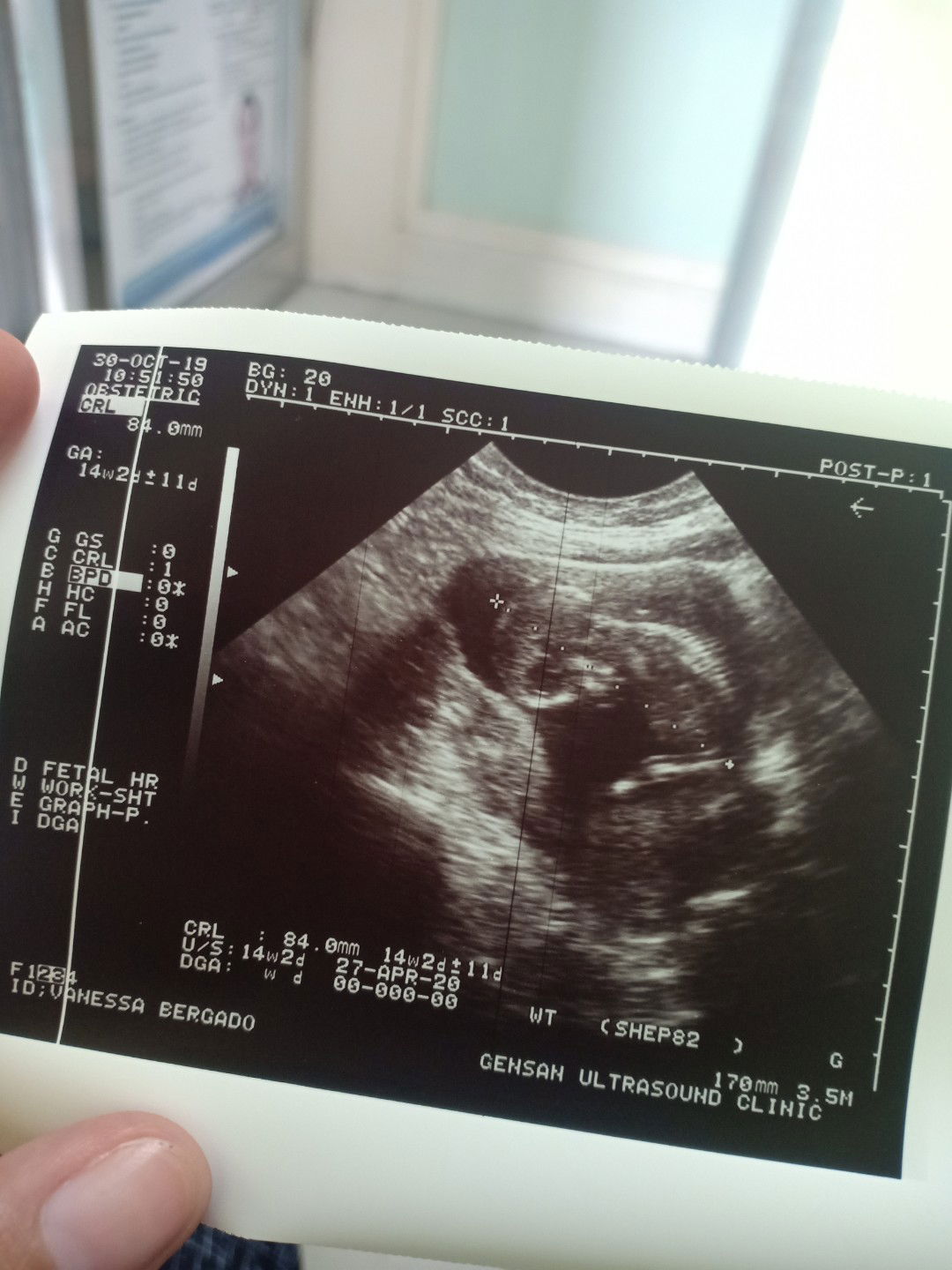 14th week contraction